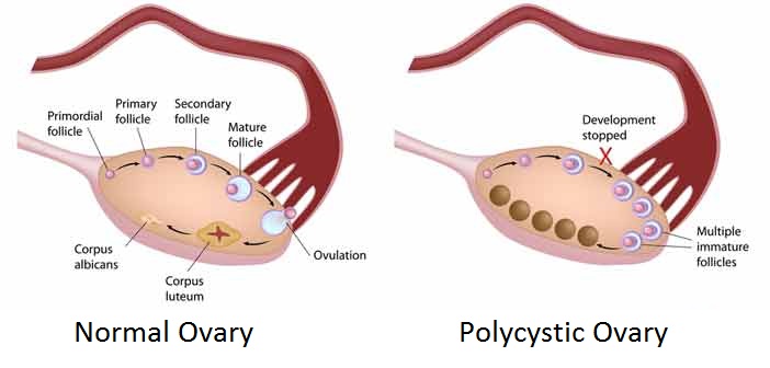 Polycystic Ovary Syndrome in Gurgaon Gynaecologist for Polycystic Ovaries treatment