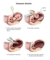 C-Section Delivery by an Expert Obstetrician Best Maternity Treatments in Gurgaon by Dr. Garima Sawhney