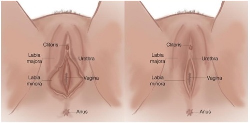 Cosmetic Labiaplasty in Gurgaon laser labiaplasty in gurgaon