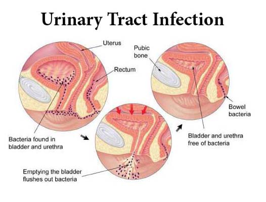 best doctor for urine infection (UTI) in gurgaon