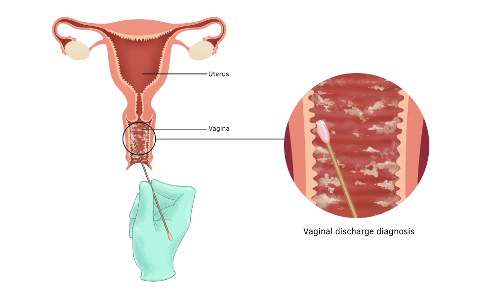 Yeast Infection Vaginal Treatment Clinic In Gurgaon Best gynaecologist for vaginal Discharge Treatment gurgaon