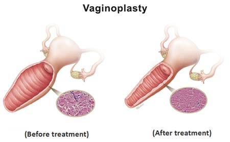 Vagina Reconstruction Surgery in Gurgaon vaginoplasty clinic in gurgaon