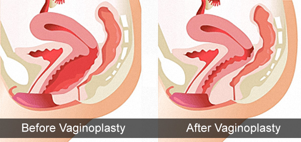 Vaginoplasty Treatment in Gurgaon vaginal tightening treatment in gurgaon
