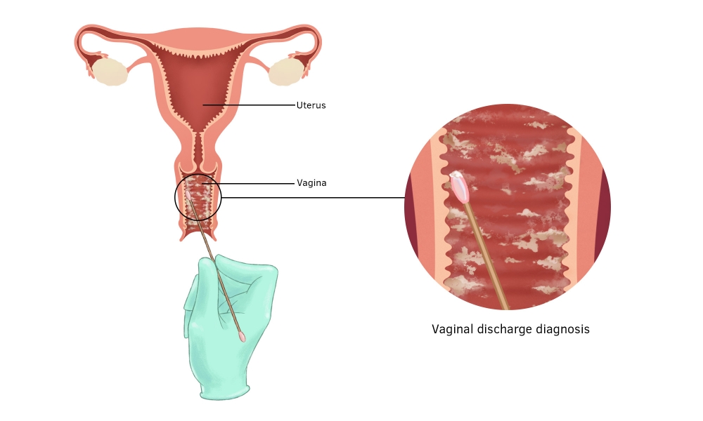 Best gynaecologist for vaginal Discharge Treatment gurgaon